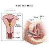 Биопсия, как способ лечения шейки матки